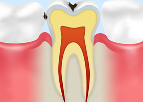 C1【エナメル質の虫歯】