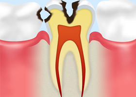 C2【象牙質の虫歯】