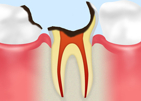 C4【歯根まで達した虫歯】