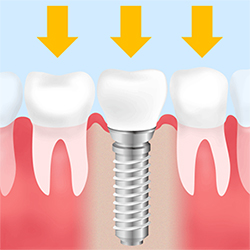 インプラント