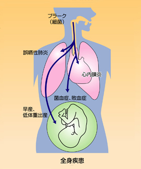 歯周病はお口の中以外にも影響を与える病気です